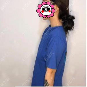 找洛阳华美田会建做了假体隆胸 恢复后的效果没让我失望很满意