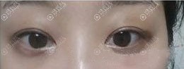 双眼皮过宽如何矫正 双眼皮过宽如何矫正