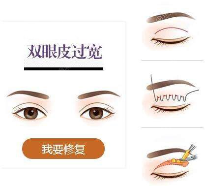 双眼皮过宽如何修复? 双眼皮过宽如何修复?