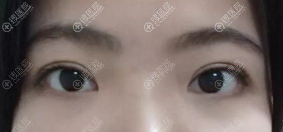����Ǩ��������˫��Ƥ�ָ���������Ȼ�޺�