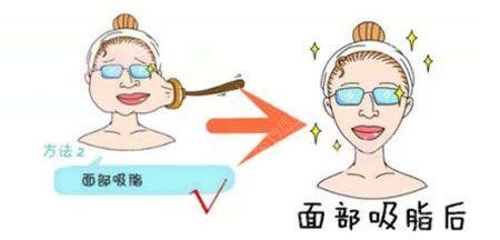 面部吸脂瘦脸 面部吸脂瘦脸