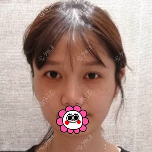 在兰州时光花了近万元做面部脂肪填充你们觉着贵吗?