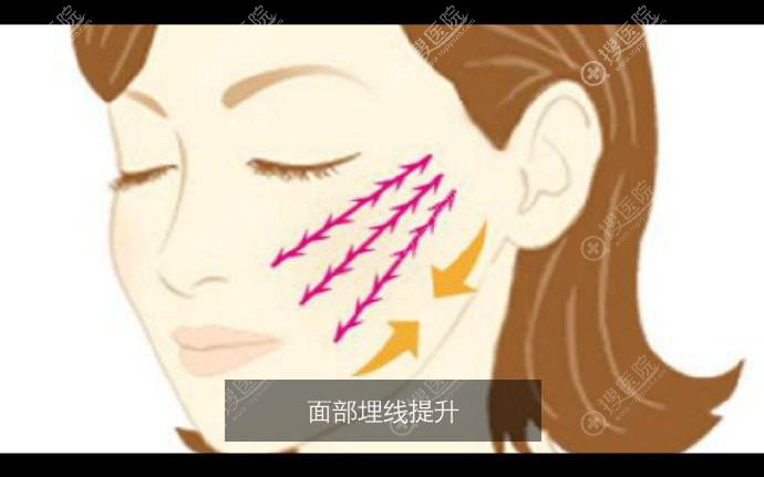 什么是面部埋线提升? 什么是面部埋线提升?