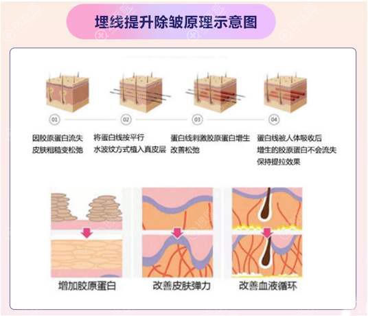 面部埋线提升原理图 面部埋线提升原理图