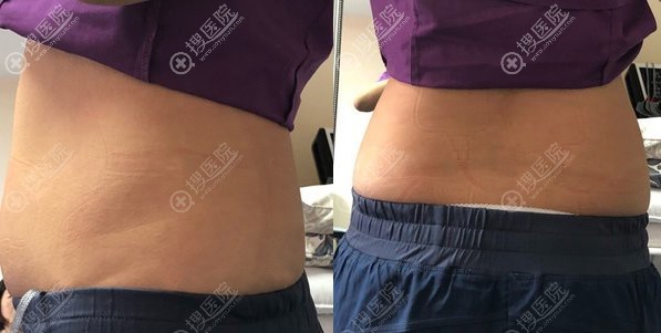 我在北京美莱做完腰腹吸脂恢复后有了漂亮的腰线也突出饱满胸型