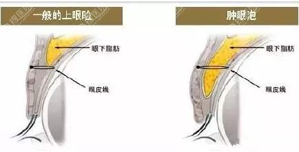 正常上眼睑和肿泡眼的区别图 正常上眼睑和肿泡眼的区别图