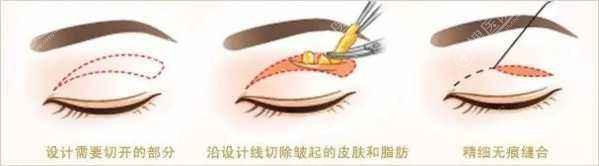 割双眼皮祛除肿眼泡 割双眼皮祛除肿眼泡