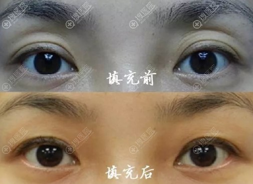 祛除眼部脂肪过多 祛除眼部脂肪过多
