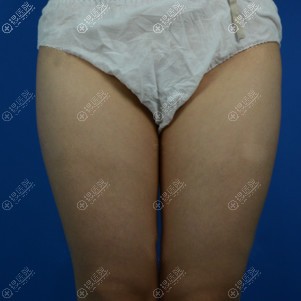 管不住嘴也迈不开腿所以就到昆明艺星做了大腿吸脂