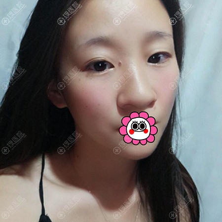 打听苏州美贝尔文国忠做鼻子的人还挺多 分享亲身经历作参考