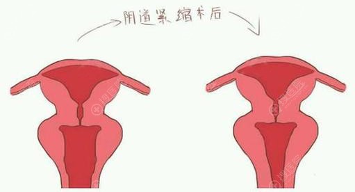 激光紧缩阴道前后对比 激光紧缩阴道前后对比