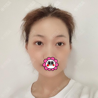 在贵阳美贝尔做自体脂肪面部填充 一个月基本定型后就可以侧睡