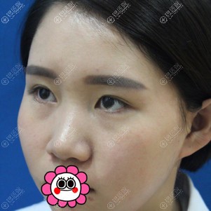 在贵阳美莱找梁洁做的膨体隆鼻花了一万多 恢复后鼻型很适合我