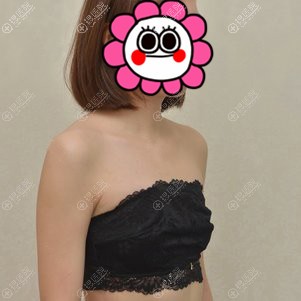 为大家说说我在海南瑞韩找杨永成做假体隆胸后的感受如何