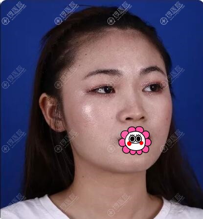 双眼皮隆鼻是在厦门薇格一起做的,不但没风险还变美了