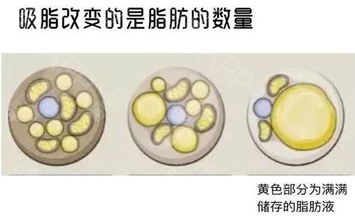 吸脂主要作用是减少脂肪的数量 吸脂主要作用是减少脂肪的数量