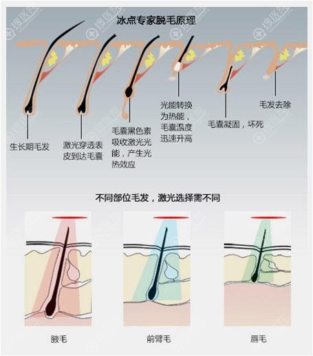 激光脱毛原理 激光脱毛原理