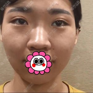 在烟台壹美找刘昆鹏做的隆鼻是水滴鼻 非常适合我的脸型