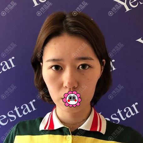 颧骨高除了刘海遮挡外到宁波艺星试试自体脂肪全脸填充提高颜值
