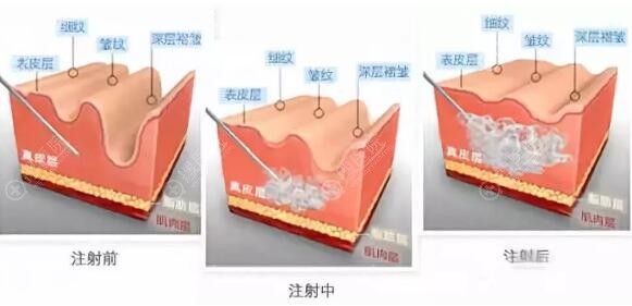 注射玻尿酸恢复原理 注射玻尿酸恢复原理