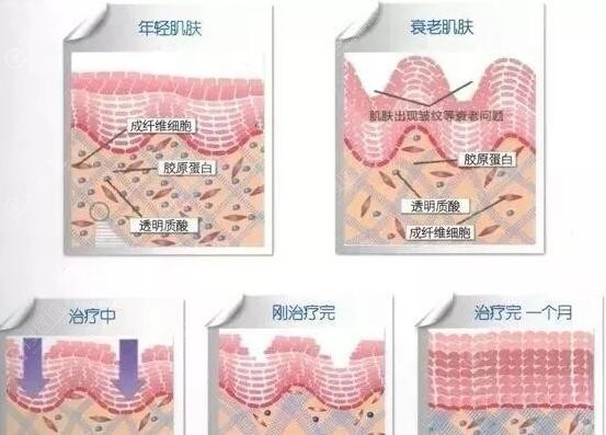 热玛吉恢复过程 热玛吉恢复过程