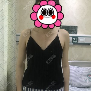 小A胸在成都军大找王家勇做自体脂肪丰胸200cc,三个月恢复满意
