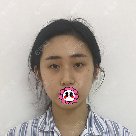 到无锡施尔美做双眼皮前 到无锡施尔美做双眼皮前