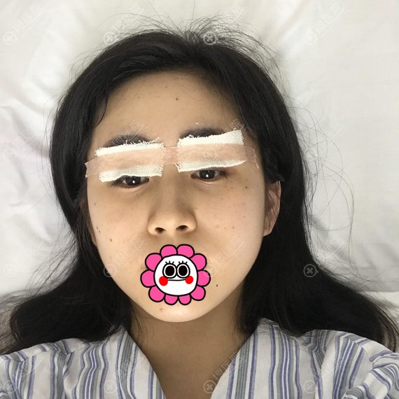 双眼皮术后即刻 双眼皮术后即刻