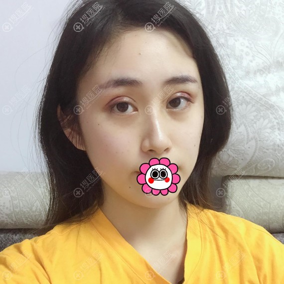 双眼皮七天到医院拆线 双眼皮七天到医院拆线