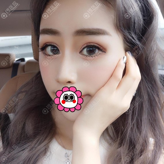 双眼皮恢复一个月效果 双眼皮恢复一个月效果