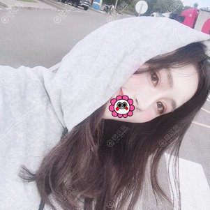 无锡施尔美王章霞双眼皮效果 无锡施尔美王章霞双眼皮效果