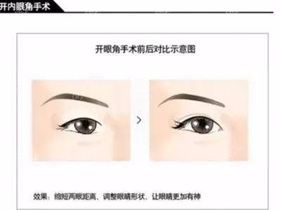 内眦赘皮开眼角效果对比 内眦赘皮开眼角效果对比
