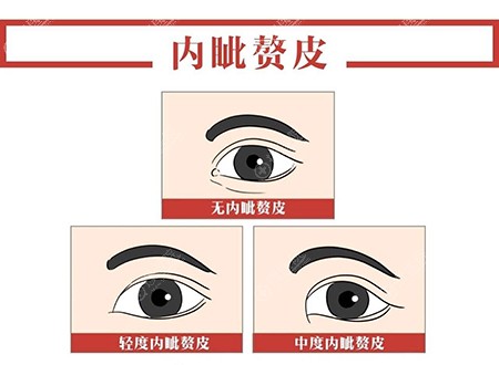 有内眦赘皮和无内眦赘皮区别 有内眦赘皮和无内眦赘皮区别