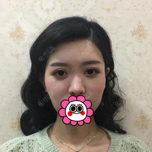 没想到大脸找重庆艺星的罗宁川做自体脂肪填充面部后也能变小