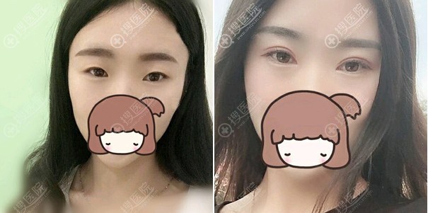汕头华美朱洙玉双眼皮案例 汕头华美朱洙玉双眼皮案例