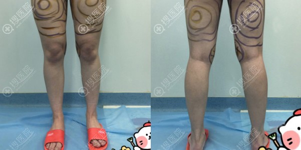 虽然做完大腿吸脂后不想穿塑身裤,但我还是坚持穿了两个月