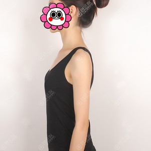 找长春中妍费博文吉做了曼托假体隆胸花了2万多效果还不错