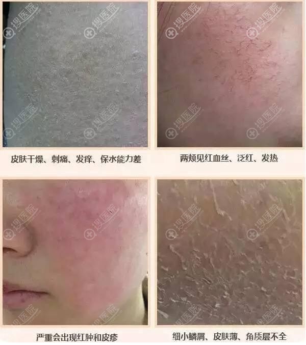 敏感肌形成的原因 敏感肌形成的原因