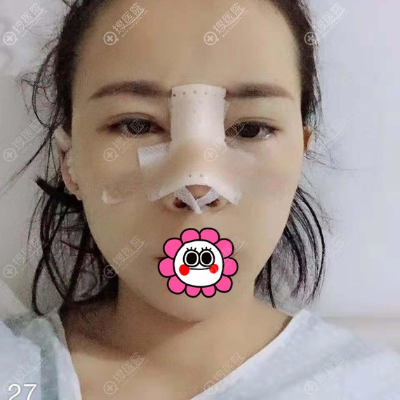 耳软骨隆鼻术后即刻 耳软骨隆鼻术后即刻