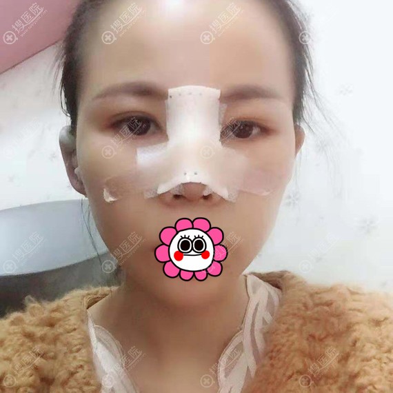 鼻综合手术术后恢复3天 鼻综合手术术后恢复3天