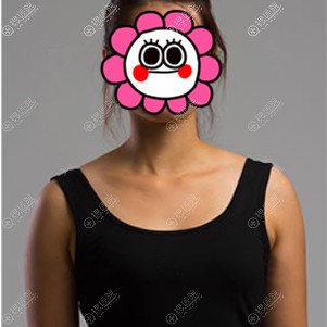 平胸被称为假小子所以找桂林星范叶向东做了花样年华假体隆胸