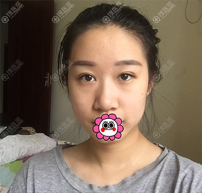 鼻整形价格有高有低,我在济南海峡花近两万找徐永做了膨体隆鼻