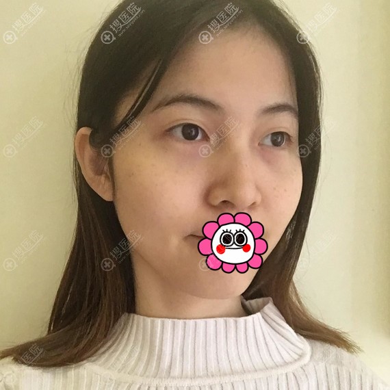 北京艺美巩敏做的面部吸脂结合溶脂塑形 术后不用带头套