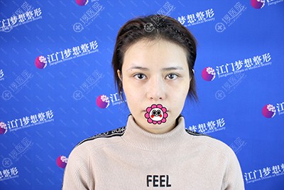 自体脂肪比玻尿酸维护时间长所以找江门梦想做了面部脂肪填充