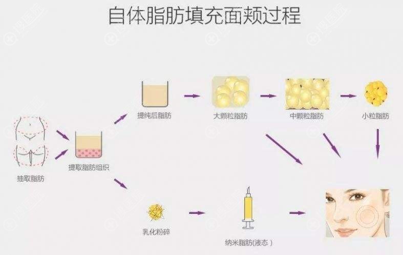 自体脂肪面部填充流程图 自体脂肪面部填充流程图