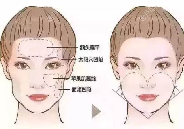面部填充术前术后效果图 面部填充术前术后效果图