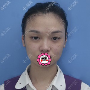 厦门海峡张宏给员工做鼻综合整形恢复后小巧精致的鼻子很适合她