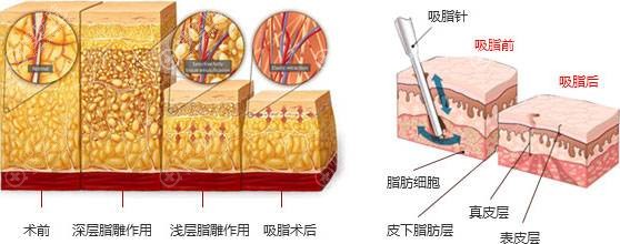 大腿吸脂原理图 大腿吸脂原理图