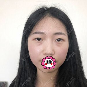 不知沈阳杏林谁做眼部整形好就找房红超做了时尚自然风格双眼皮