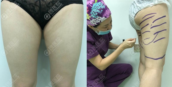 在新疆乌鲁木齐新黎美做完大腿吸脂拥有好身材后让朋友很羡慕